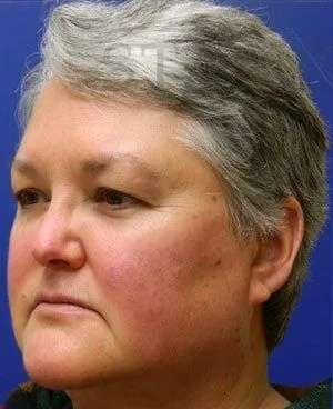 Laser Treatment Before & After Patient #655