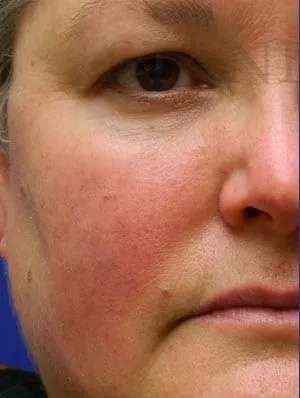 Laser Treatment Before & After Patient #655