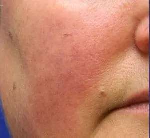 Laser Treatment Before & After Patient #655