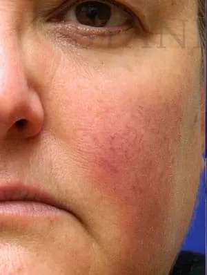 Laser Treatment Before & After Patient #655