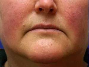 Laser Treatment Before & After Patient #655