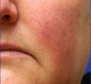 Laser Treatment Before & After Patient #655