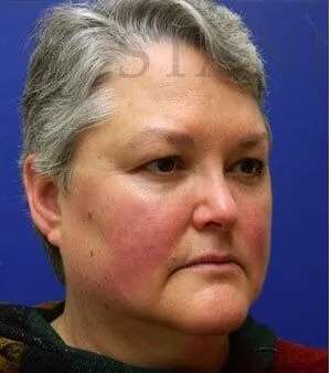 Laser Treatment Before & After Patient #655