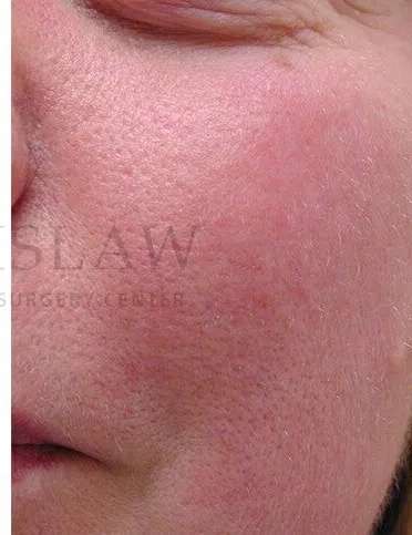 Laser Treatment Before & After Patient #627