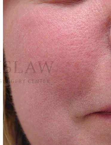 Laser Treatment Before & After Patient #627
