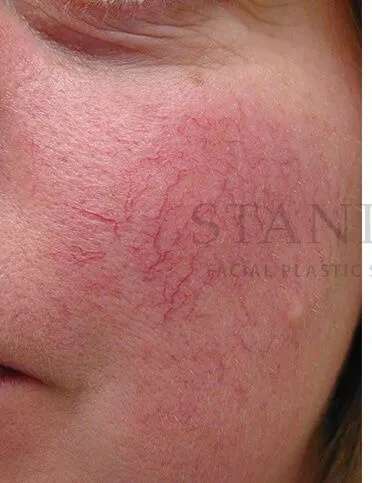 Laser Treatment Before & After Patient #627