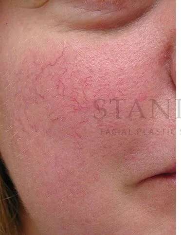 Laser Treatment Before & After Patient #627