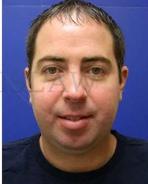 Laser Treatment Before & After Patient #638