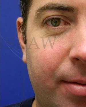 Laser Treatment Before & After Patient #638