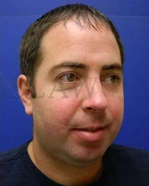 Laser Treatment Before & After Patient #638