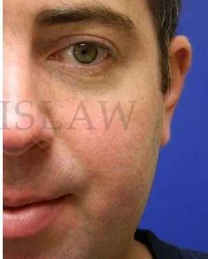 Laser Treatment Before & After Patient #638