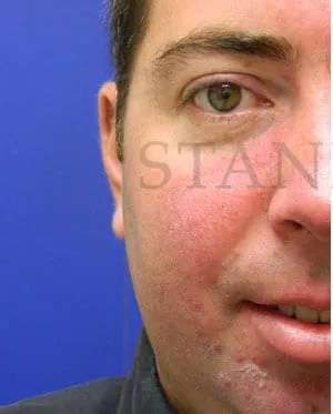 Laser Treatment Before & After Patient #638
