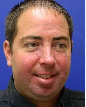 Laser Treatment Before & After Patient #638