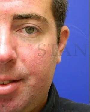 Laser Treatment Before & After Patient #638