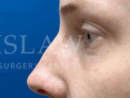 Laser Treatment Before & After Patient #615