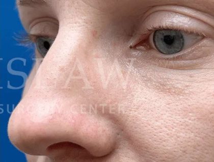 Laser Treatment Before & After Patient #615