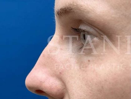 Laser Treatment Before & After Patient #615