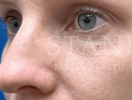 Laser Treatment Before & After Patient #615