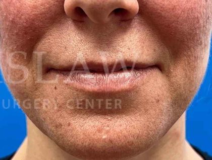 Lip Reconstruction Before & After Patient #669