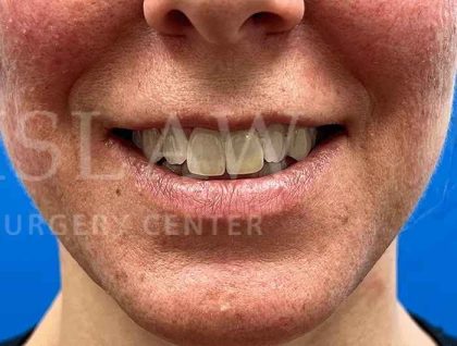 Lip Reconstruction Before & After Patient #669