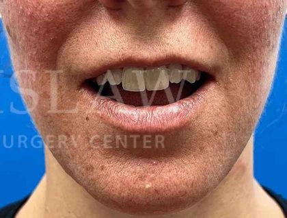 Lip Reconstruction Before & After Patient #669