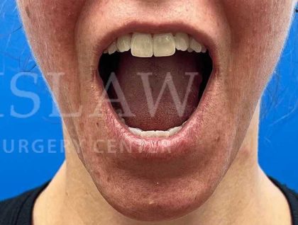 Lip Reconstruction Before & After Patient #669