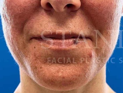 Lip Reconstruction Before & After Patient #669