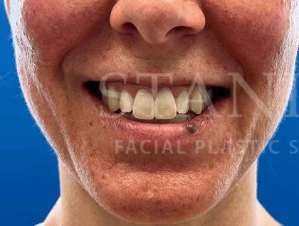 Lip Reconstruction Before & After Patient #669