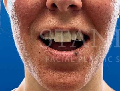 Lip Reconstruction Before & After Patient #669
