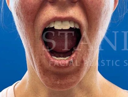 Lip Reconstruction Before & After Patient #669