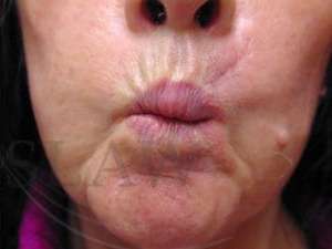 Lip Reconstruction Before & After Patient #706