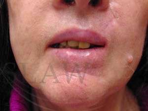 Lip Reconstruction Before & After Patient #706