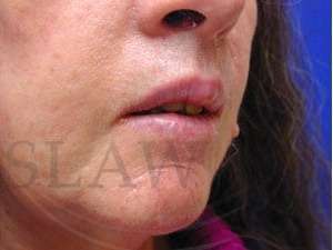 Lip Reconstruction Before & After Patient #706