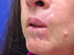 Lip Reconstruction Before & After Patient #706