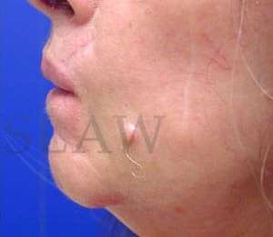Lip Reconstruction Before & After Patient #706