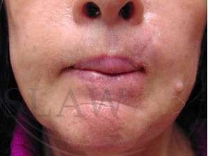 Lip Reconstruction Before & After Patient #706