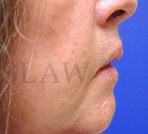 Lip Reconstruction Before & After Patient #706