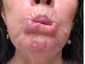 Lip Reconstruction Before & After Patient #706