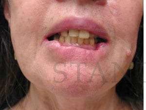 Lip Reconstruction Before & After Patient #706