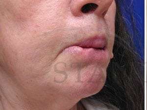 Lip Reconstruction Before & After Patient #706