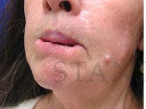 Lip Reconstruction Before & After Patient #706