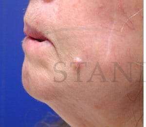 Lip Reconstruction Before & After Patient #706