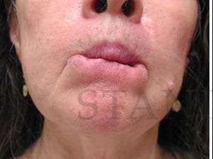 Lip Reconstruction Before & After Patient #706