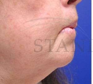 Lip Reconstruction Before & After Patient #706