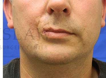 Lip Reconstruction Before & After Patient #691