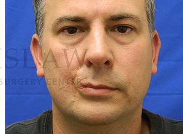 Lip Reconstruction Before & After Patient #691