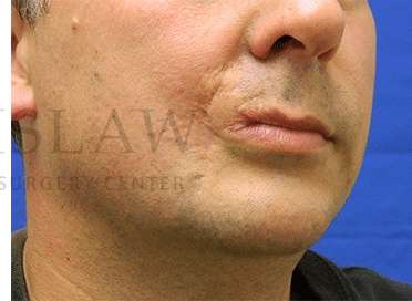 Lip Reconstruction Before & After Patient #691