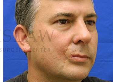 Lip Reconstruction Before & After Patient #691
