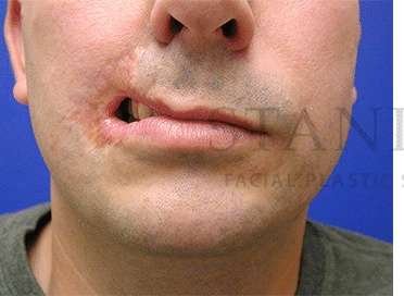 Lip Reconstruction Before & After Patient #691