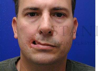 Lip Reconstruction Before & After Patient #691